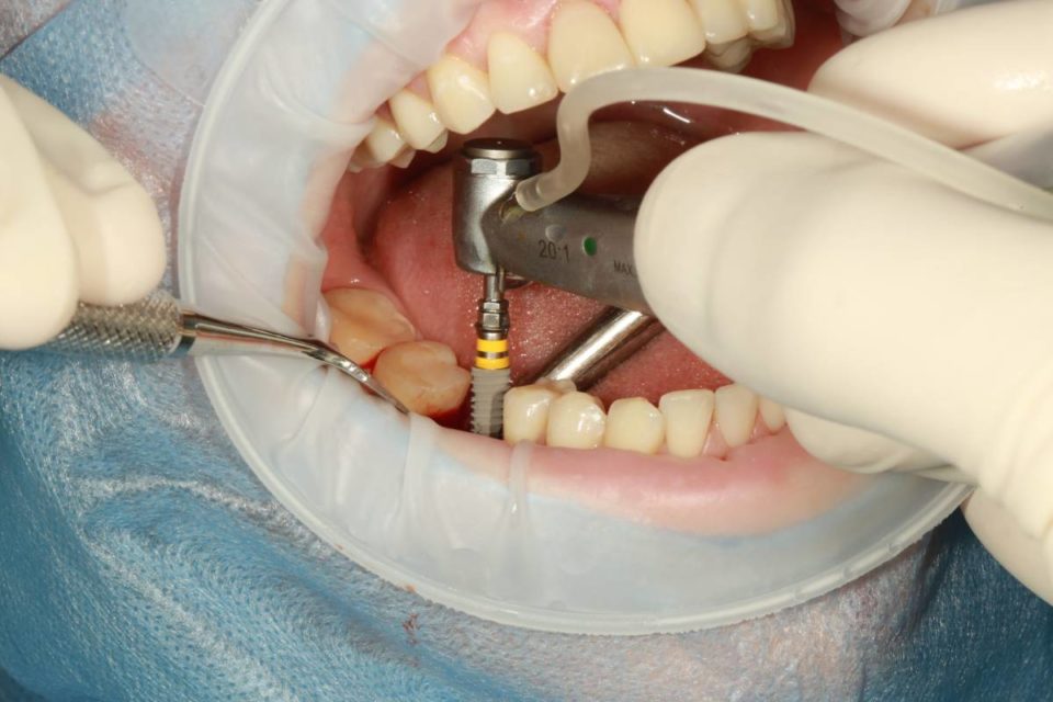 4 Dental Implants Maintenance Guide